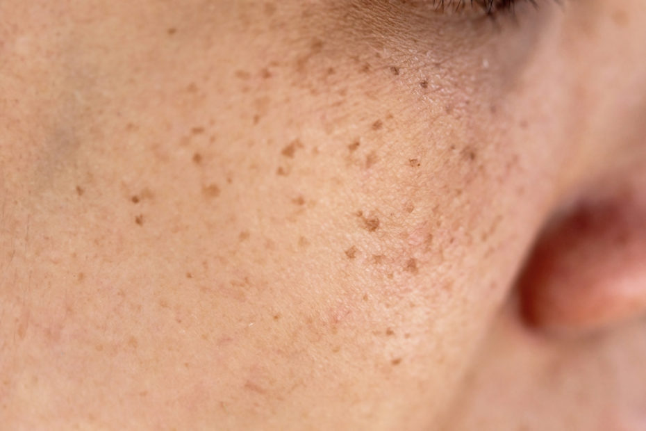 Cómo eliminar las manchas de la piel de la cara